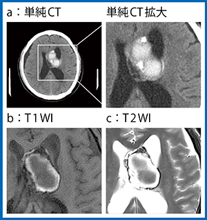 図1　症例1の単純CTと単純MRI