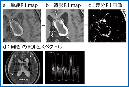 図3　症例1の造影MRIとMRSI