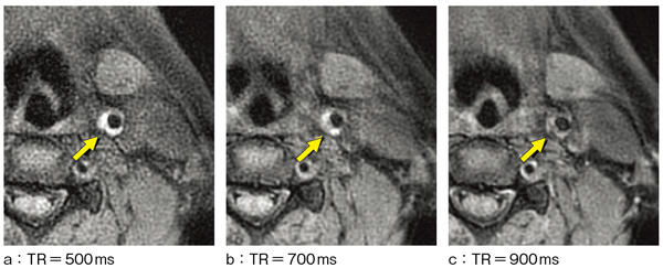 図1　T1強調SE像におけるTRの違いによるプラークイメージングの比較1）