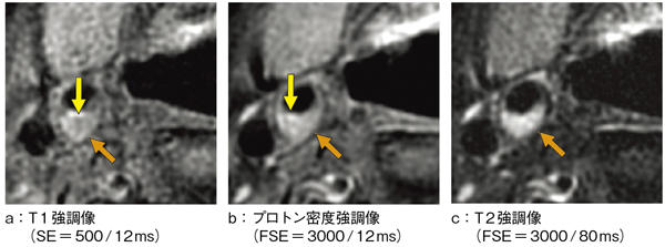 図2　標準化案に則って撮像したMRプラーク画像1）