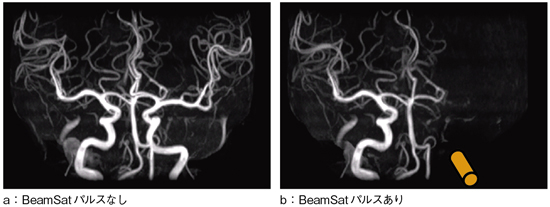 図4　BeamSat TOF画像（健常例）