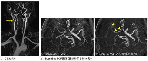 図5　CE-MRA画像とBeamSat TOF画像（右頸部内頸動脈狭窄）