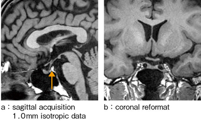 図2　isoFSE T1強調画像（下垂体部の拡大）