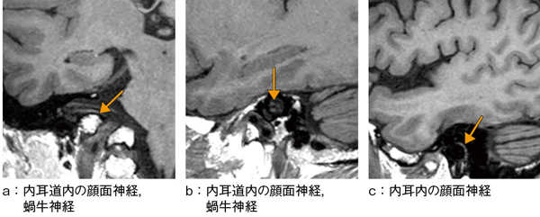 図3　isoFSE T1強調画像（内耳・中耳領域の拡大）