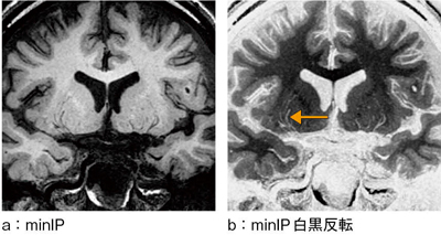 図4　isoFSE T1強調画像