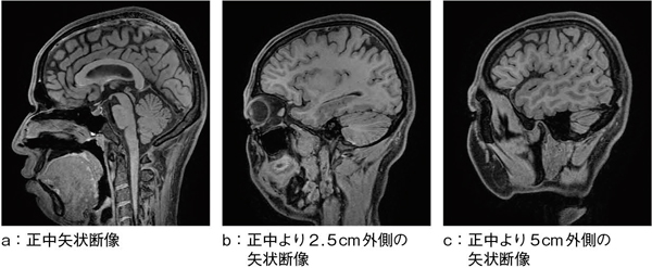 図5　脂肪抑制併用isoFSE T1強調画像（1mm isotropic data） Aq.time 5min 28s