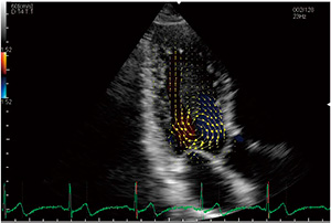 図1　左室の速度ベクトル表示（等容収縮期）