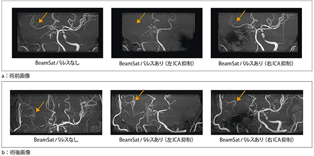 図3　STA-MCAバイパス手術前後のBeamSat TOF画像