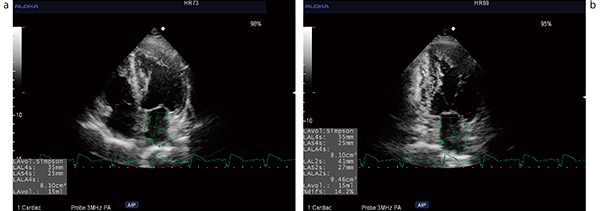 図4　セミオートによる左房容量計測結果
