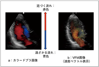 図1　カラードプラ画像とVFM画像の例