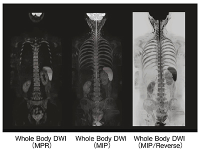 図3　Whole Body DWI画像例