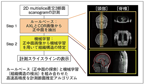 図2　人工知能による画像診断装置の高度化の例：MRI自動撮像位置決め