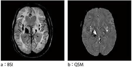 図6　脳出血のBSIとQSM画像比較