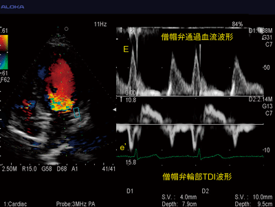 図4　Dual DopplerによるE/e’の評価