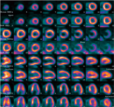 図1　Philips PET/CT装置による13NH3心筋PET検査の画像例