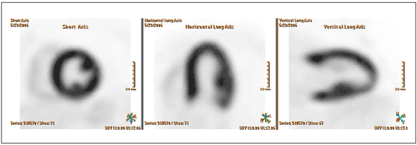 図6　GEMINI TF PET/CTによるToF-PET画像（90秒収集）