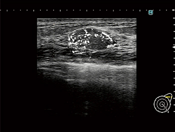 図4　DFI乳腺画像