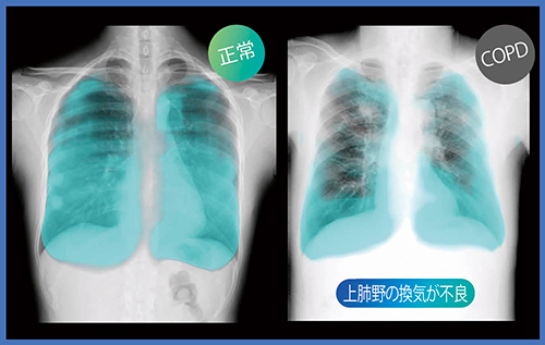 図3　COPDの肺野内濃度変化