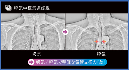 図4　呼気中枢気道虚脱の周波数強調処理