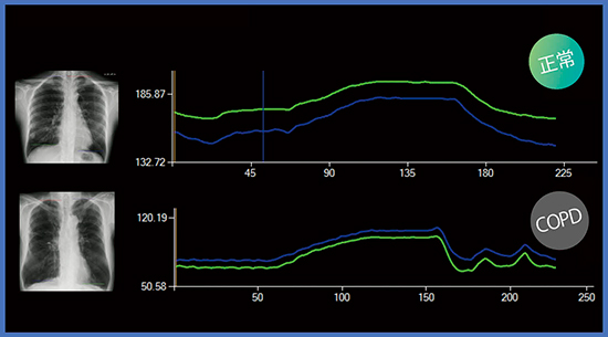 図5　横隔膜（COPD）の定点追跡