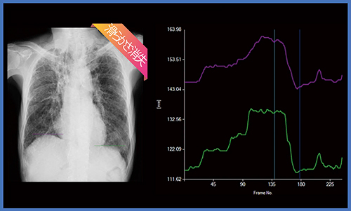 図6　肺線維症（間質性肺炎）の定点追跡