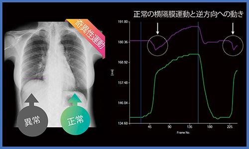図7　右の横隔神経麻痺の定点追跡
