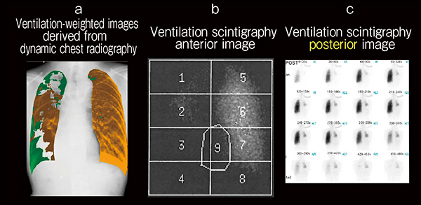 図2　右肺がん切除術・放射線治療後（68歳，男性） a：換気強調画像　b，c：肺換気シンチグラフィ画像