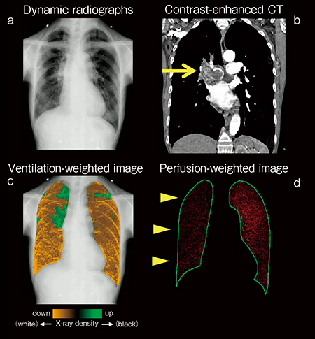 図3　右肺動脈血栓塞栓症例（75歳，女性） a：X線動態解析画像　b：造影CT画像 c：換気強調画像　d：血流強調画像