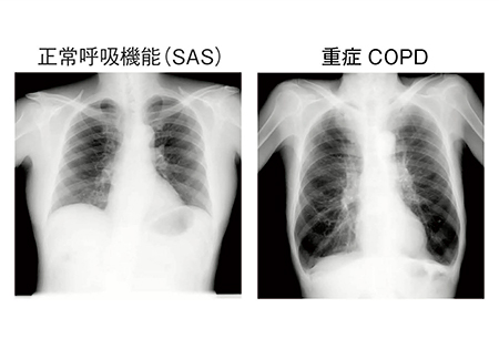 図3　正常呼吸機能（睡眠時無呼吸症候群）と重症COPDの画像比較