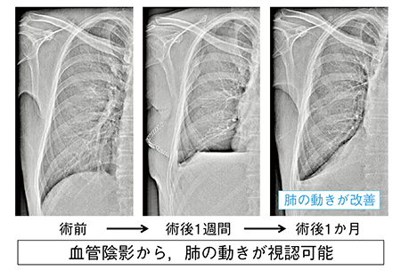 図1　肺切除術後の経過観察