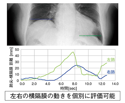 図2　横隔膜神経麻痺の確認