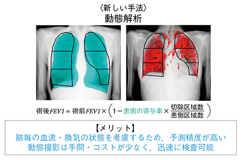 図1　動態解析による術後呼吸機能予測