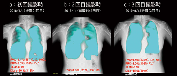 図2　症例3：肺胞低換気症候群のPL-MODE画像