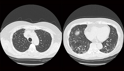 図1　症例1：胸部単純CT画像