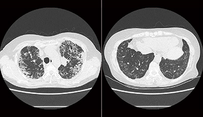 図4　症例2：胸部単純CT画像