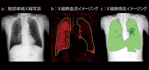 図2　症例2：巨細胞性動脈炎，左肺動脈高度狭窄