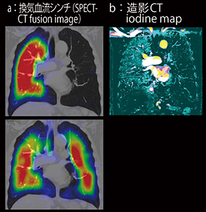 図3　症例2の肺換気血流シンチグラフィおよび造影CTのヨードマップ
