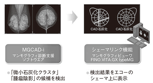 図1　マンモグラフィCADの検出結果をUS検査にも活用