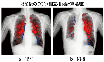 図1　右上葉肺がん切除術の改良PH-MODE