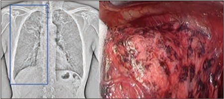図3　症例3：肺アスペルギルス症