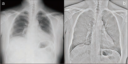 図1　BSxFE-MODEによる肺結節の描出