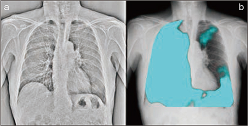 図2　PL-MODEによる肺換気の評価