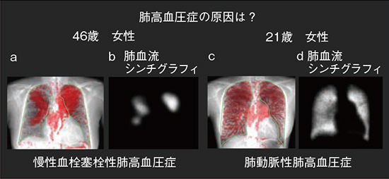 図2　症例2：肺高血圧症