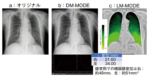 図1　症例1：COPD症例のX線動態解析結果