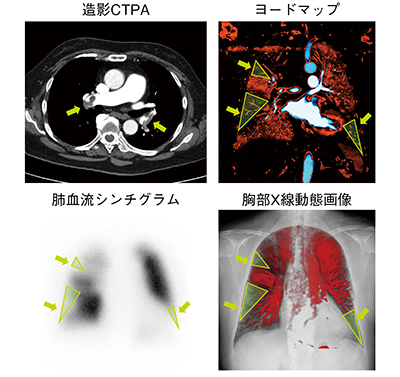 図1　肺塞栓症患者の各種検査画像