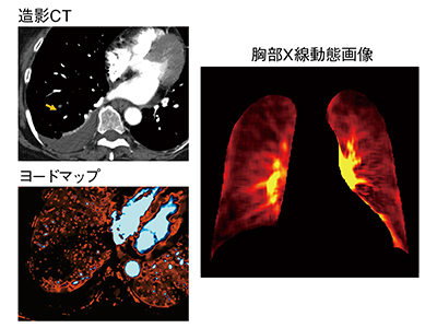 図3　小さな肺塞栓症の検出