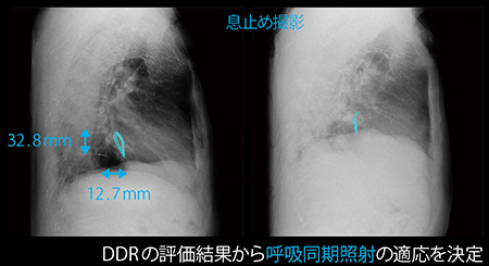 図2　症例2：呼吸同期照射の適応例