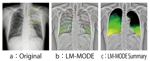 図2　症例2：胸壁浸潤性肺がん