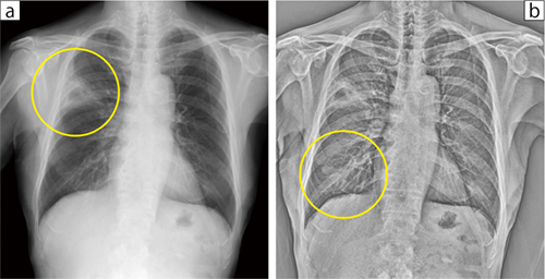 図1　症例1：癒着あり症例