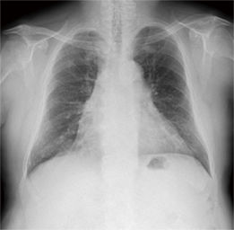 図2　症例2：癒着の予測が困難な症例